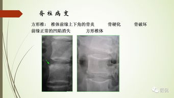 强直性脊柱炎x线表现 医学影像经典