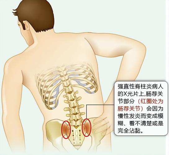 强直性脊柱炎怎么来的(引发强直性脊柱炎的原因有哪些?)