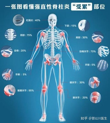 “不死癌症”:强直性脊柱炎