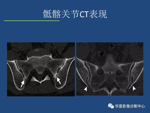 强直性脊柱炎影像诊断和鉴别诊断