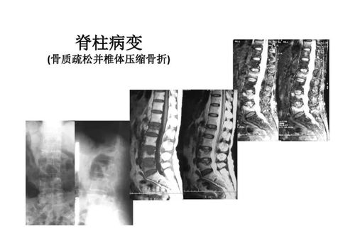 病根埋线治疗强直性脊柱炎的思路与方法