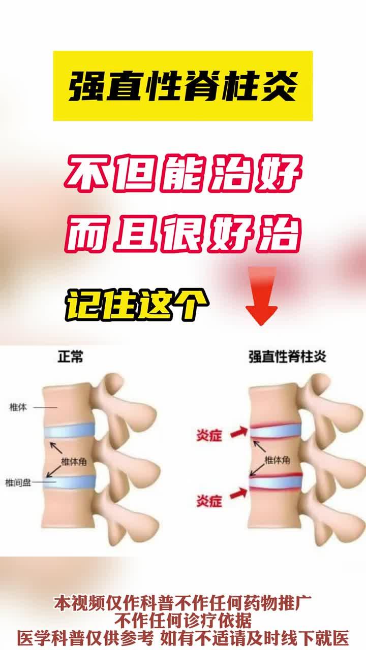 强直性脊柱炎 可有效控制的慢性疾病
