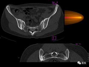 类风湿关节炎与强直性脊柱炎的影像学诊断比较