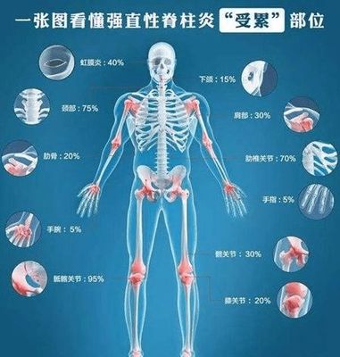 强直性脊柱炎的合理饮食指南