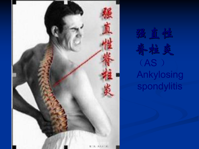 强直性脊柱炎 病因、症状与治疗