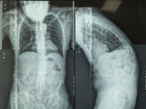 强直性脊柱炎的临床特征与治疗进展