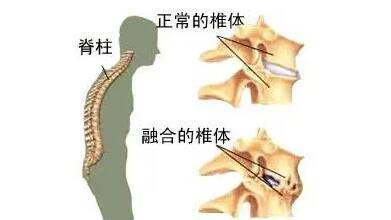 当光芒遇见痛楚 那些与强直性脊柱炎共舞的明星们