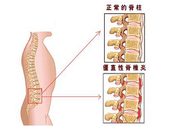 认识强直性脊柱炎 一种需要被“看见”的慢性炎性疾病
