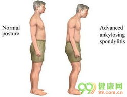 强直性脊柱炎的治疗与管理 核心注意事项解析