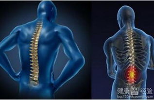 强直性脊柱炎的治疗与管理 一个全面指南