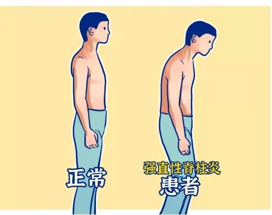 干细胞疗法 吹响攻克强直性脊柱炎的冲锋号